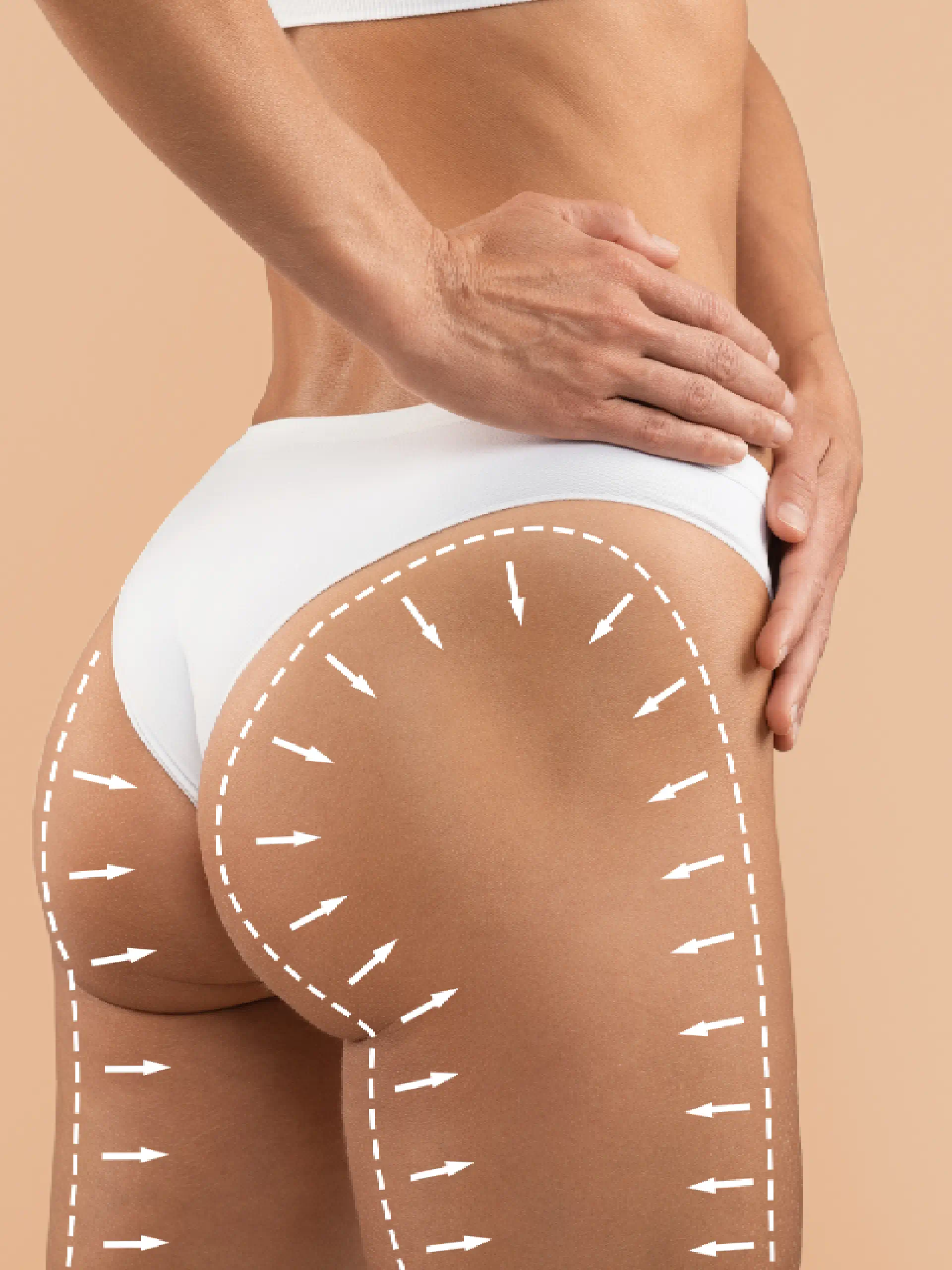 a woman's buttocks with lines drawn on it