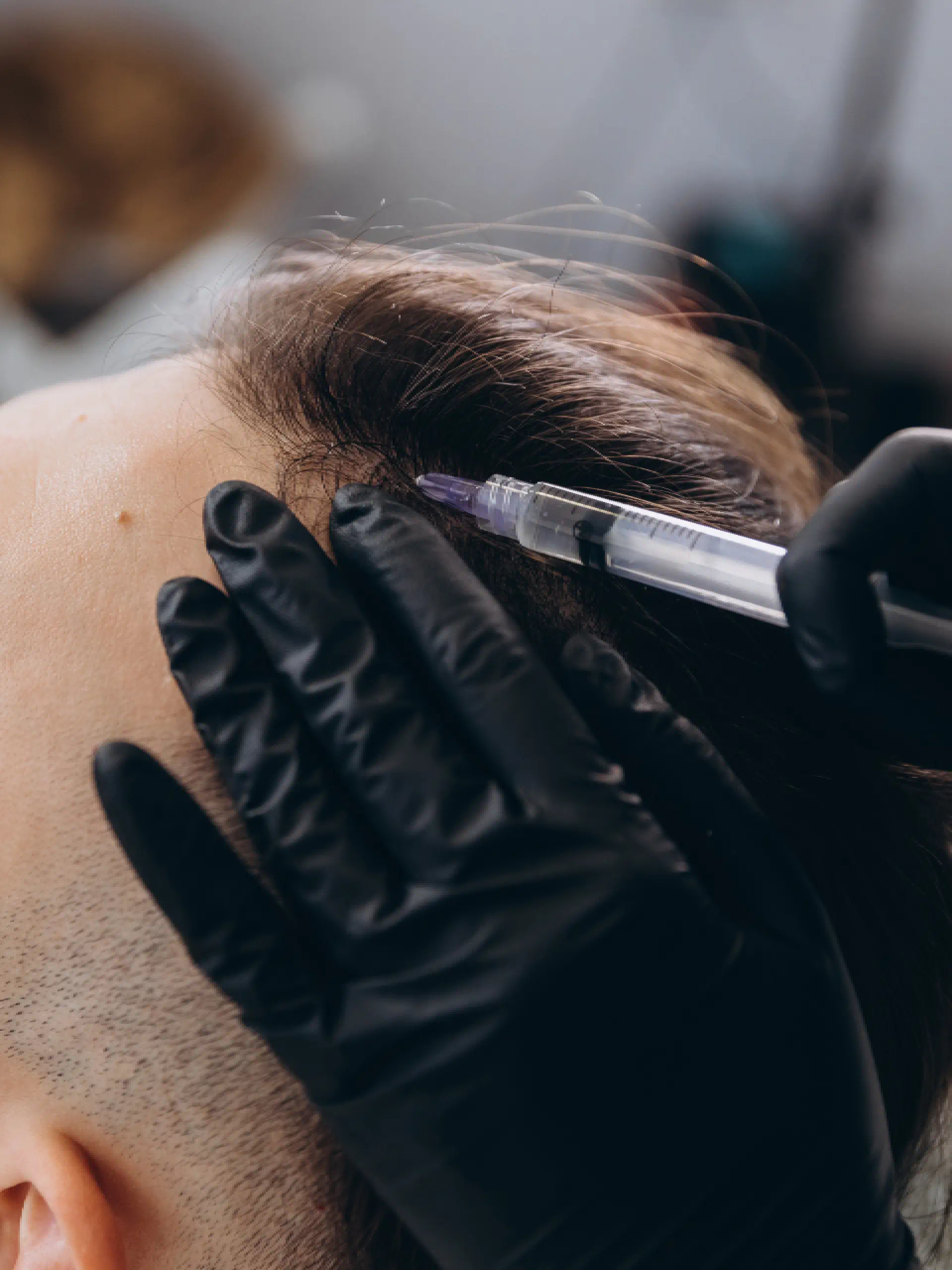 a person getting hair injection